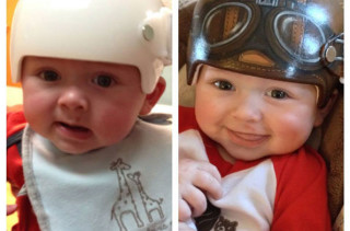 Artist Paints Baby's Medical Helmets