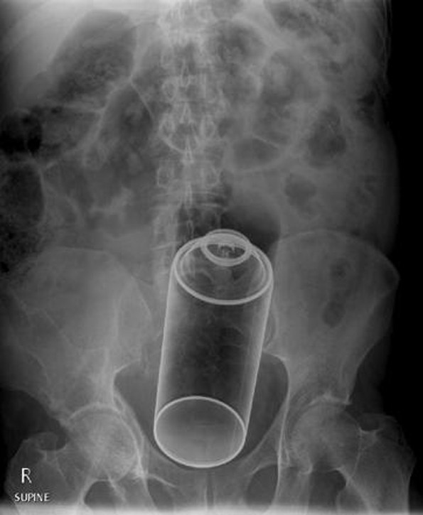X-ray Images Reveal The Weird Things People Put In Their Butts